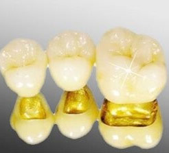 品质有保证的全瓷牙贴面价格